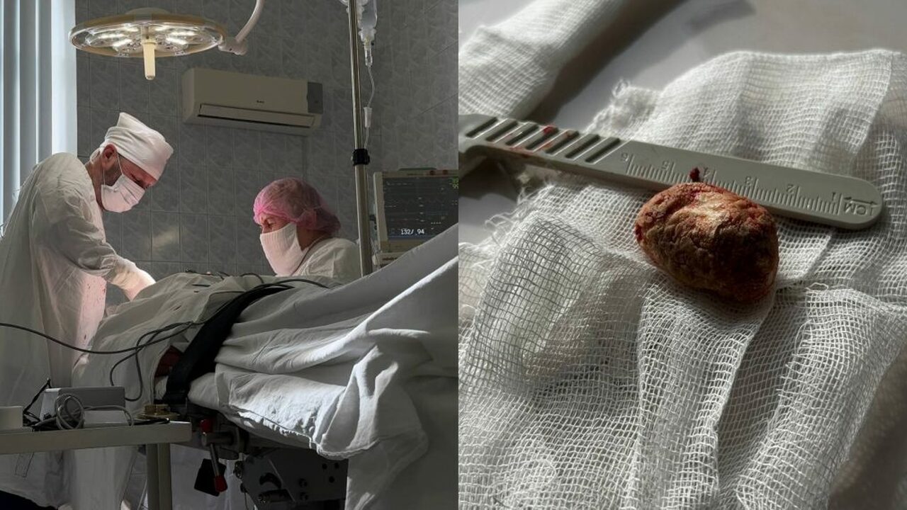Ульяновские хирурги удалили огромный камень из слюнной железы пациента В Ульяновской областной клинической больнице пр...