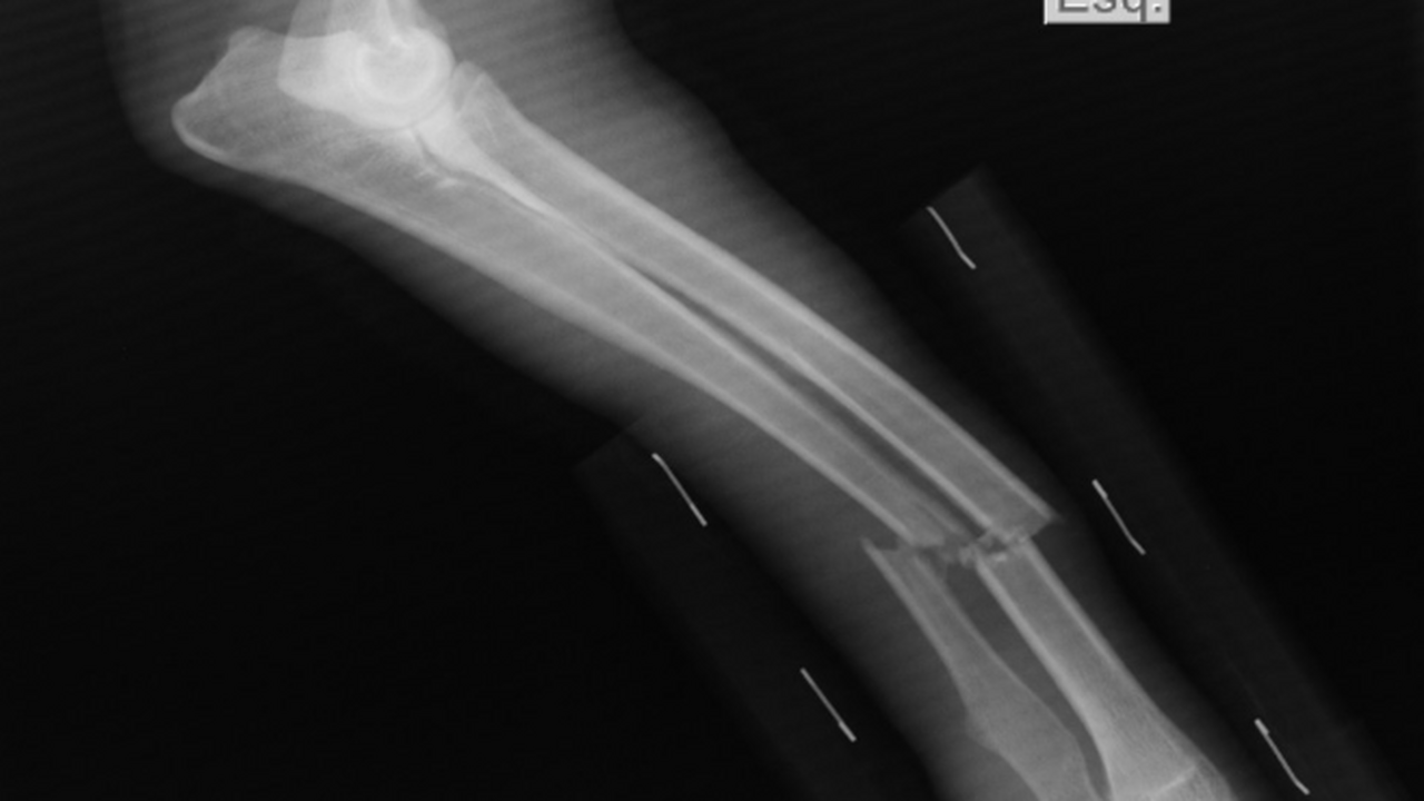 Японские ученые разработали метод лечения переломов Исследователи из Осакского столичного университ...