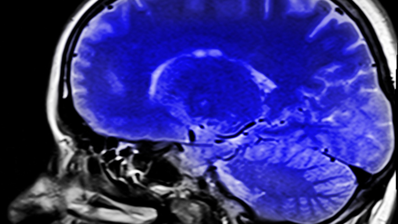 Radiology: избыток железа в мозге может увеличивает риск деменции Учёные из Университета Джонса Хопкинса обнаружи...